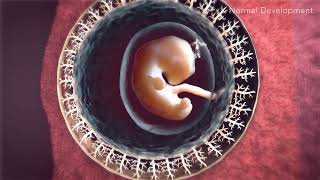 Animated Portrayal of Placenta Accreta Spectrum [upl. by Roscoe]