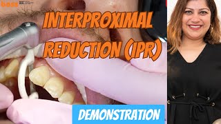 HowTo Perform Interproximal Reduction IPR for Orthodontic Treatment  a clinical demonstration [upl. by Calvin115]