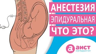 Как делается эпидуральная анестезия при родах [upl. by Naedan]