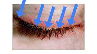 A New Treatment Approach for Blepharitis and Crusty Eyelids [upl. by Roch]