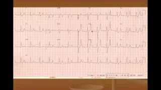 Hyperkalemia Treatment and ECG Changes [upl. by Ohcamac117]