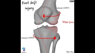 Contrecoup injury ACL tear [upl. by Ydaf]