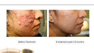 Moderate to Cystic Acne Treatment Advancements with 650microsecond Laser Technology [upl. by Ahsitel274]