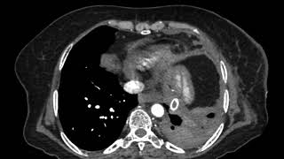 TMT XRAY CHEST LEFT OPAQUE HEMITHORAX [upl. by Kwarteng]