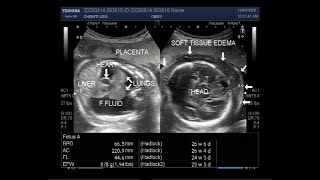 Ultrasound Video showing Hydrops fetalis Soft tissue edeme and Fetal pleural effusion [upl. by Ardnoek]