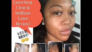 My Clear amp Brilliant Laser Review After 2 Sessions for Acne Scars LaserAway [upl. by Arliene311]