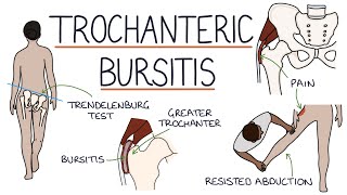 Understanding Trochanteric Bursitis [upl. by Gabriella]