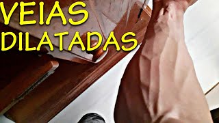 🔴Como ter VEIAS SALTADAS Sem usar hormônios dilatadas dilatação [upl. by Sirrot]