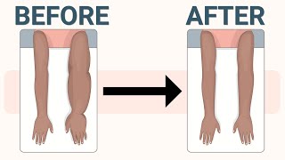 Treatment for Arm Lymphedema and Swelling after Cancer Surgery [upl. by Len]