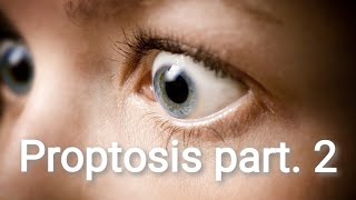 Orbit  Proptosis Diagnosis and Treatment Part 3 [upl. by Ixel]