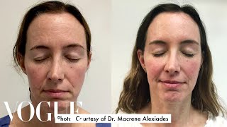 One Woman Gets 15 Cosmetic Procedures in 12 Months  Vogue [upl. by Ravo]