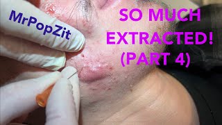 So much extracted Severe acne before and after Session 2 Comedones for days [upl. by Adnarim]