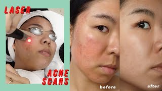 Picosure Laser for Acne Scars amp Hyperpigmentation Before amp After [upl. by Jessica]