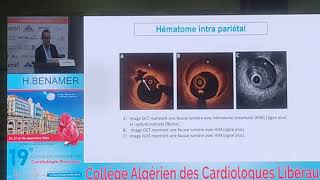 Infarctus du myocarde chez les femmes [upl. by Handel734]