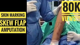 Skew Flap for Below Knee Amputation Skin Marking for perfect Stump [upl. by Wassyngton853]