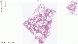 Miliary Tuberculosis  Histopathology [upl. by Swane]