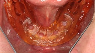 LODI Implant Placement Using an InOffice 3D Printed LODI Surgical Guide [upl. by Anazraf]