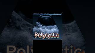 Follicular Ovary  Polycystic Ovaries  PCOS  PCOD  Dominant Follicle on Ultrasound [upl. by Ocana108]