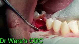 Immediate implant placement in mandibular molar region [upl. by Amitaf301]