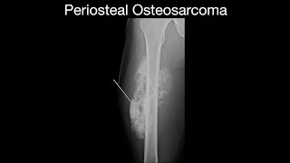 Periosteal Osteosarcoma [upl. by Ymereg27]