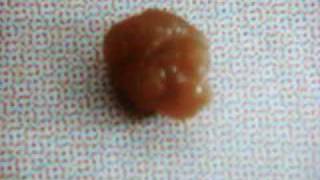 Ureteric stone URIC ACID STONE URETERIC COLIC [upl. by Ayhay]