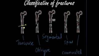 Classifying and presenting Fractures  Orthopaedics for Medical Students  Finals [upl. by Ardeth80]