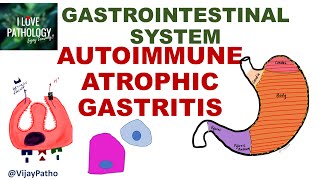 AUTOIMMUNE ATROPHIC GASTRITIS Pathogenesis clinical features morphology amp prognosis [upl. by Neron]