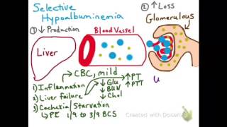 Selective Hypoalbuminemia [upl. by Mandell241]