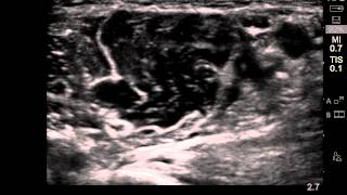 ultrasound guided musculocutaneous nerve block [upl. by Yorel]