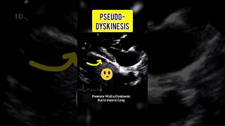 Pseudo Dyskinesia shorts trending echocardiography heartdisease cardiology [upl. by Ahtram]