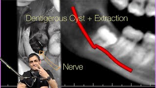 Dentigerous Cyst and Lower Wisdom Tooth with Four Roots Watch my podcast DrWahanExperiment [upl. by Oballa]