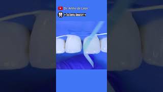 CLOSING The Diastema While Replacing The Old Stained Restoration dental toothrestoration [upl. by Adnohsek]