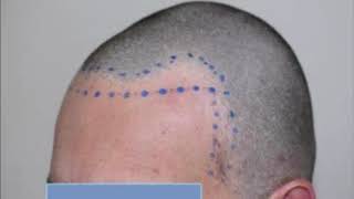 Dr Keser 1330 Grafts Hair transplant result 7 Months [upl. by Anayik185]