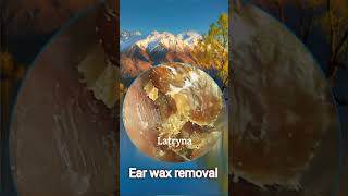 Ear wax removal Satisfying Ear Wax Removal [upl. by Munster]