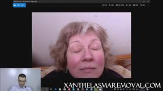 Xanthelasma Removal With TCA [upl. by Margarita]