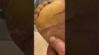 Fissure crack maintenance  Keratoderma Callus EPPK Hyperkeratosis  May 8 2023 [upl. by Spike210]