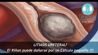 LITIASIS URETERAL  Dr Roy Mamani [upl. by Dnesnwot807]