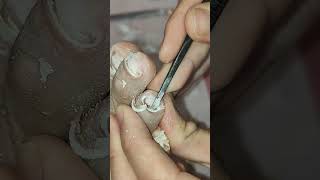 Callus removal and Dead skin removal from Feet ep78  Yin Clinic [upl. by Ancelin]