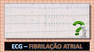 ECG  Eletrocardiograma com Fibrilação Atrial e Alta Resposta Ventricular [upl. by Esinrahc911]