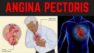 ANGINA PECTORIS  Chest Pain  Types  Causes Risk factors  NITROGLYCERIN  Management [upl. by Caesar]