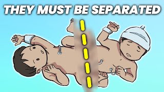 What Happens When Conjoined Twins Must Be Separated [upl. by Mattias]