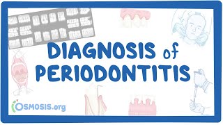 Diagnosis of Periodontitis [upl. by Johnsten]