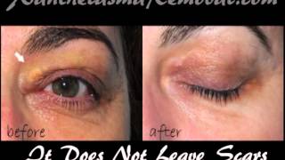 Xanthelasma removal at home without scarring the most time saving and cost effective solution [upl. by Nagel925]