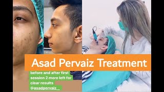 PRP Plus Microneedling by Zarpash Khan  Asad Parvaiz [upl. by Lemmueu]