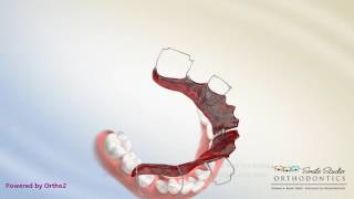 Schwartz Appliance  Lower Expander  Orthodontic Treatment [upl. by Alva]