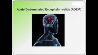 ADEM Acute disseminated encephalomyelitis History Management mrcpch Clinical [upl. by Arenat]