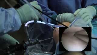 Arthroscopic Knee Surgery Meniscus Tear [upl. by Mallis]