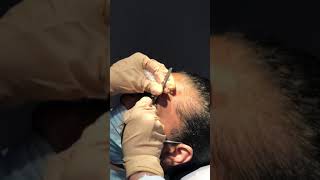 Chalazion removal part 3 ophthalmologyoptomterymeibomianglandchalazioneyelidmedical optometry [upl. by Gotthelf989]