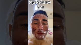 7 Meses depois do procedimento de Fenol Profundo para tratar cicatrizes de acne [upl. by Anavi]