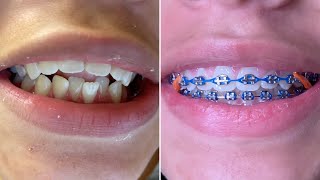 Braces on  2 years with braces  Tongue Crib RPE  Tooth Time Family Dentistry New Braunfels Texas [upl. by Ecirtael]